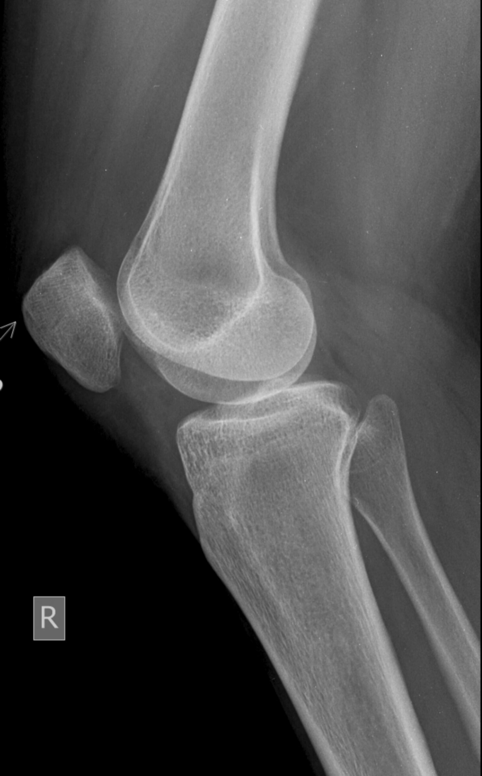 Lateral view x ray of human knee joint