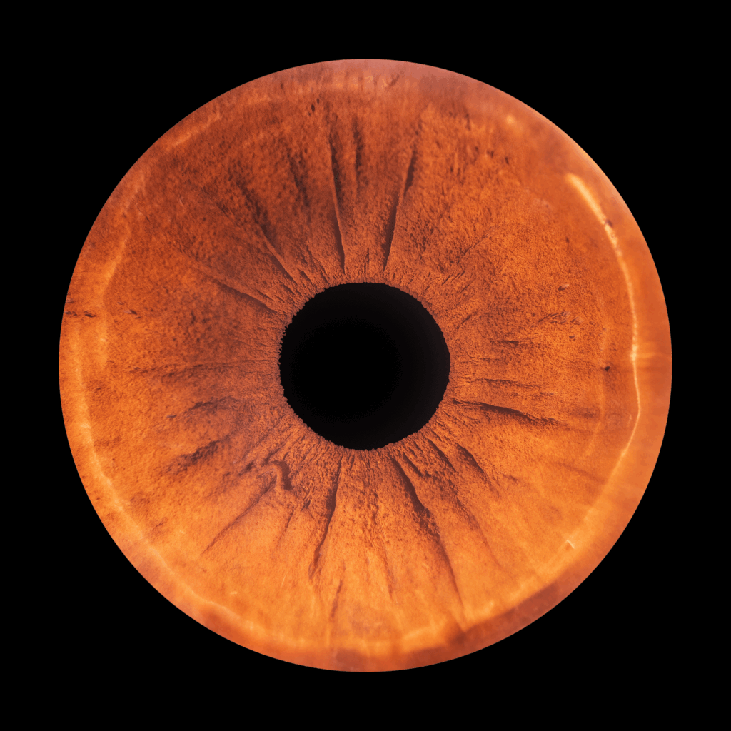 Background retinopathy